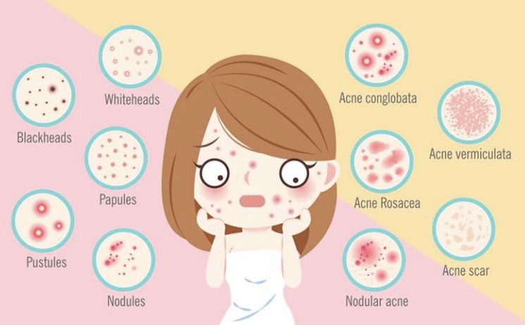 các bước skincare cho da mụn hình 5