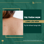 Trị mụn thâm mụn lưng lâu năm